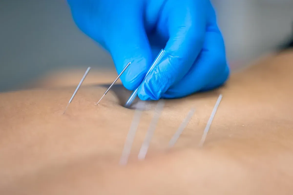 IMS/Dry Needling: Effective Pain Relief