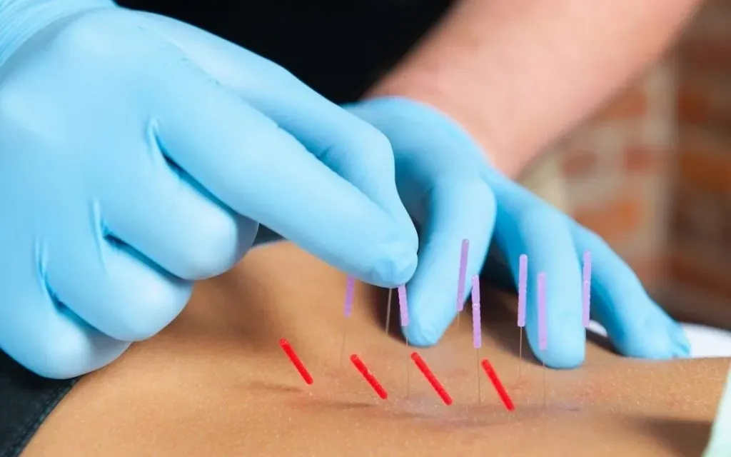 It's All About IMS/ dry needling